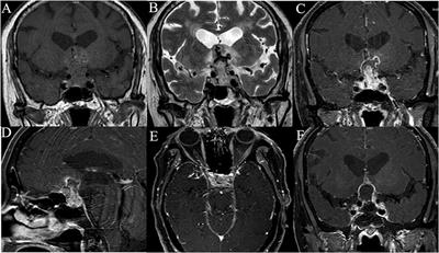 Frontiers | Adult Sellar Region Atypical Teratoid/Rhabdoid Tumor: A ...